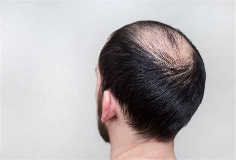 Signs Of Balding In Men And What To Do About It Regenrx