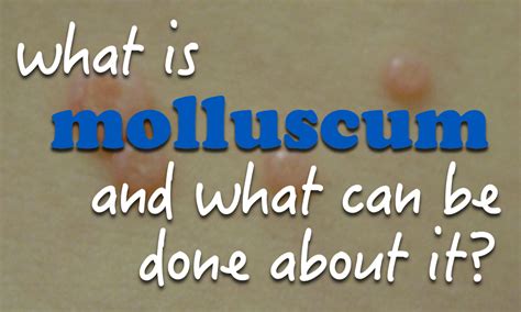 What Is Molluscum And What Can Be Done About It Naturopathic Pediatrics
