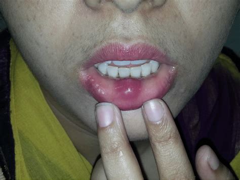 Bump On Lips Swollen Bump On Lip Images And Photos Finder
