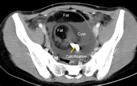 Mature Ovarian Teratoma Radiology Cases