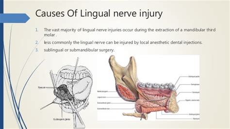 Management Of Lingual Nerve Injury