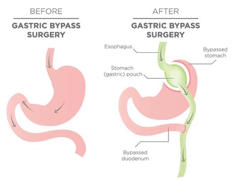 Weight Loss Surgery Gastric Band Gastric Bypass Mr