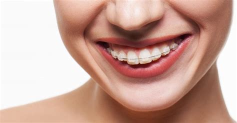 Best Adult Orthodontics Treatment Karachi Affordable Free Consultation