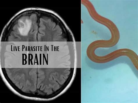 Live Parasitic Worm Found In Australian Woman S Brain In World First