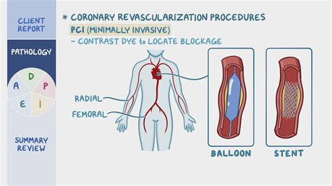 Coronary Artery Disease CAD And Angina Pectoris Nursing Process