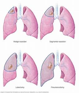 Lung cancer surgery - Mayo Clinic Lung Cancer  