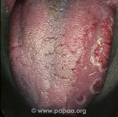 Pictures Of Psoriasis And Psoriatic Arthritis Papaa