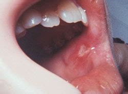 White Sores On Floor Of Mouth Viewfloor Co