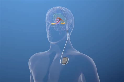 Clinical Trial Looks At Deep Brain Stimulation For Mild Alzheimers