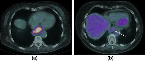 Pet Ct In The Uk Current Status And Future Directions Clinical Radiology