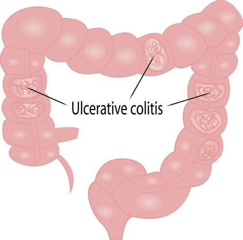 Therapy For Ulcerative Colitis Ibs Clinics