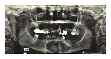 Panoramic Radiograph Shows A Single Large Radiolucent Lesion With