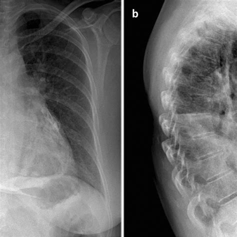 Posteroanterior A And Lateral View B Of The Patients Chest X Ray