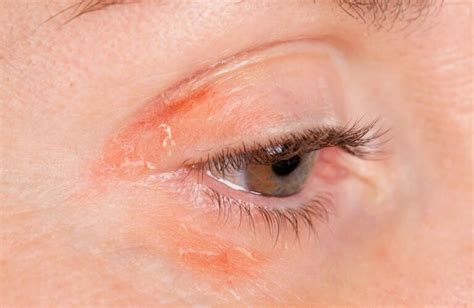 Face Psoriasis What To Do For Psoriasis Near Eyes