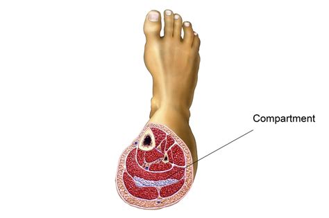 Chronic Exertional Compartment Syndrome In ­athletes A Narrative