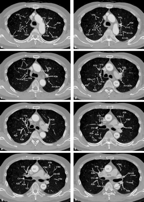 6 Pulmonary Artery And Vein Radiology Key