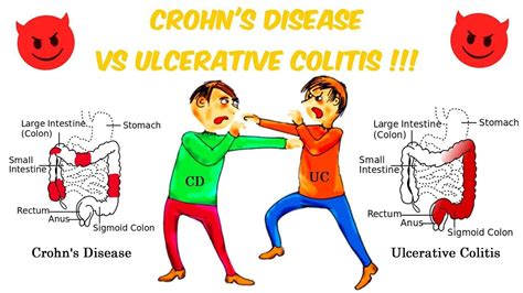 How To Diagnose Crohns Disease