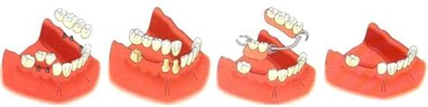 Tipos De Puentes Dentales Clínica Dental Tafur