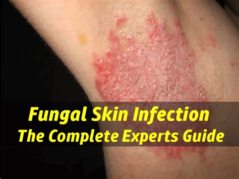 Fungal Infection Skin Folds