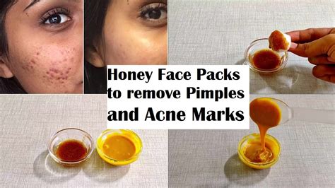honey face packs to remove pimples and acne marks naturally at home how to use honey for