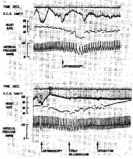 Vagal Reflex Response To Laryngoscopy The Upper Panel Shows The