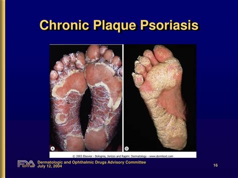 Ppt Introduction To Psoriasis Powerpoint Presentation Free Download