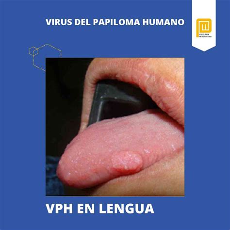 Virus Del Papiloma Humano S Ntomas Y Tratamiento Policl Nica