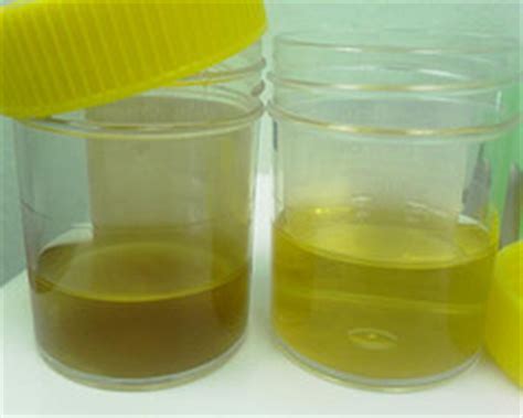 Protein in urine: Causes & Risk factors | Men's Health articles ...
