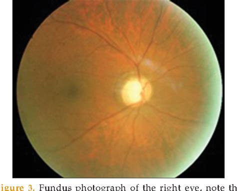 Figure 3 From Pigmentary Glaucoma With Retinochoroidal Pigmentation