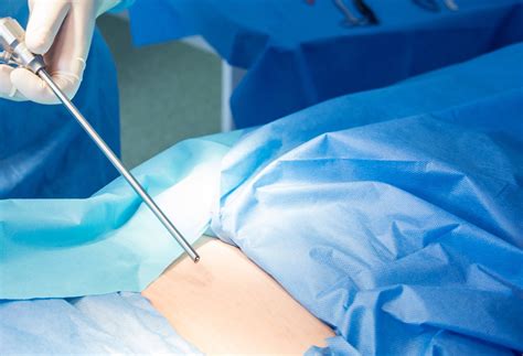 Microdiscectomy And Microdecompression Nyc