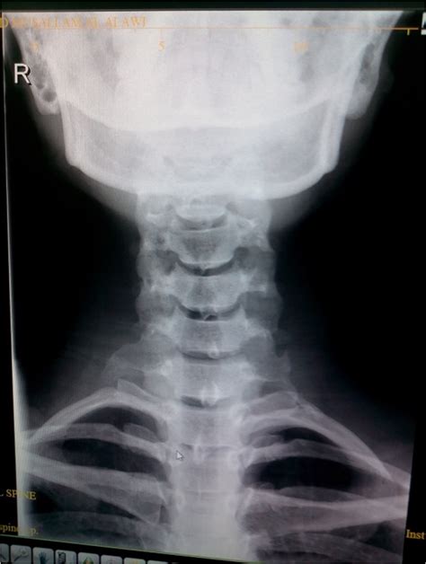 Figure 2 X Ray Neck Showing Right Sided Cervical Rib Of Patient No 7