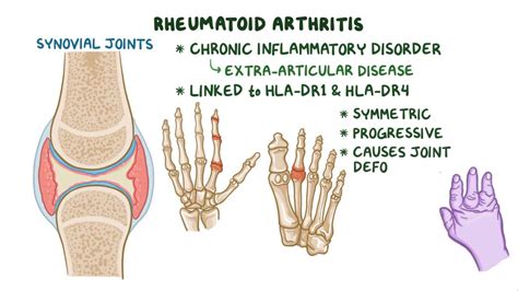 Rheumatoid Arthritis Clinical Video And Anatomy Osmosis