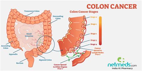 Funny Colon Cancer Symptoms Signs