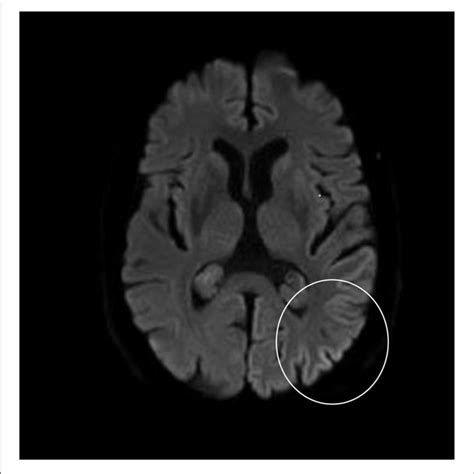 High Signal Intensity Of The Left Parieto Occipital Cortex On