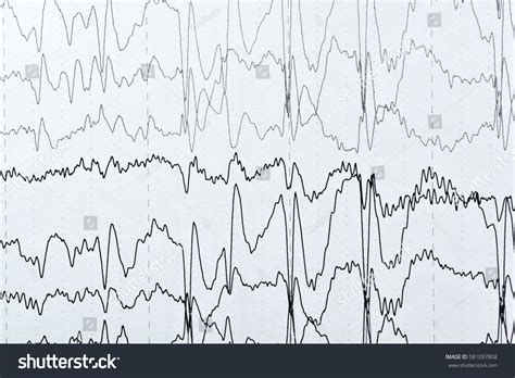 Abnormal Eeg Brain Wave On Electroencephalogrameeg Stock Photo Edit
