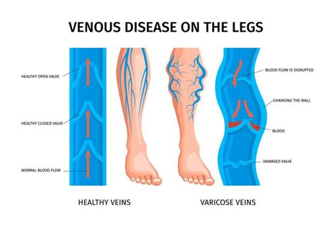 A Closer Look At Chronic Venous Insufficiency Understanding Symptoms