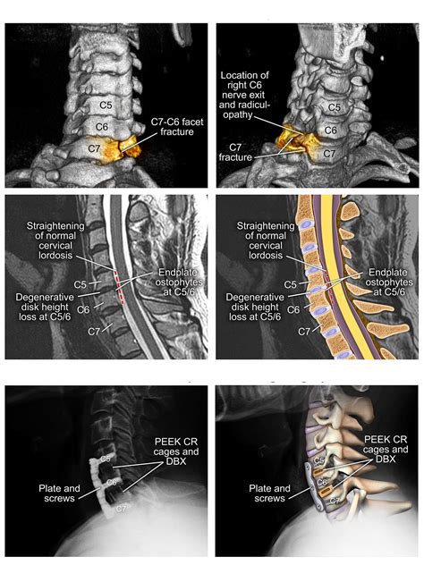 Cervical Spine Fractures And Surgical Fixation