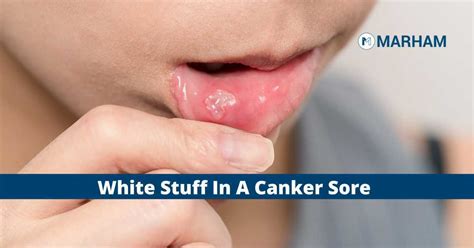 What Is The White Stuff In A Canker Sore Marham