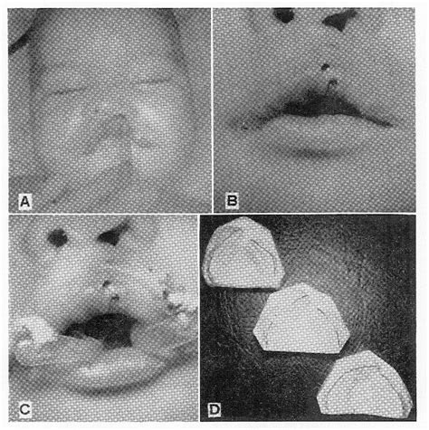 Figure 3 From Neonatal Orthopedic Correction For Cleft Lip And Palate