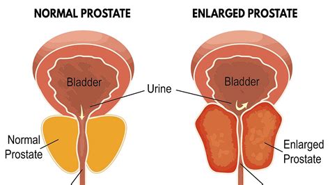 Enlarged Prostate Surgery Side Effects Effect Choices