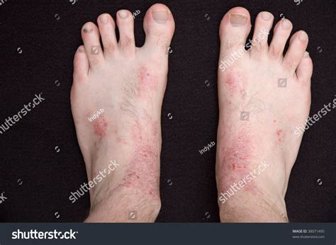Atopic Eczema On The Skin Of A Persons Feet Stock Photo 38071495