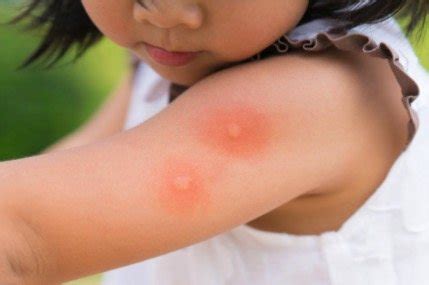What Do Bed Bug Bites Look Like Pictures Case Examples
