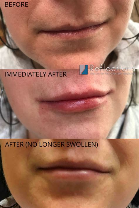 How Long Are Lips Swollen After Restylane