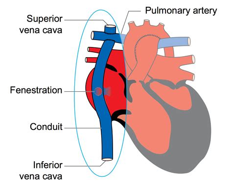 Stimulation Of Ventricular Stiffening Trough The Different Stages Of