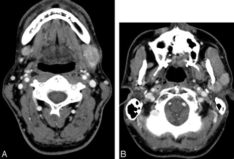 Retropharyngeal Lymph Node Metastasis From Esthesioneuroblastoma A