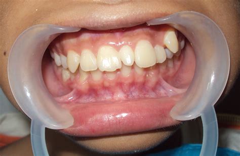 Toothfulness August 2011