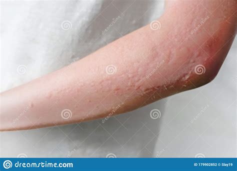 Skin Rashes Allergies Contact Dermatitis Stock Photo Image Of Rashes