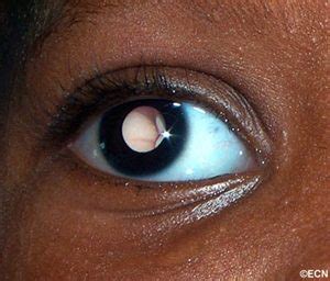 More cancer signs and symptoms. Early Retinoblastoma Screening Key to Saving Life and ...