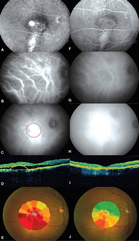 Figure 1 From Low Fluence Photodynamic Therapy In Longstanding Chronic