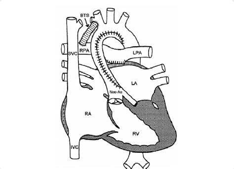 Staged Surgical Palliation Of Hypo Plastic Left Heart Syndromein Stage